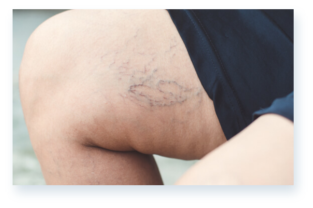 Leg symptoms visualization