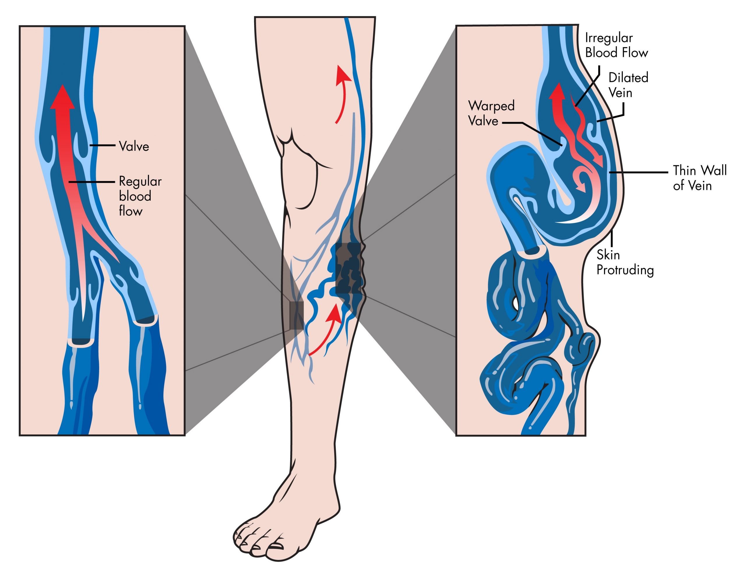 Venous valve dysfunction diagram