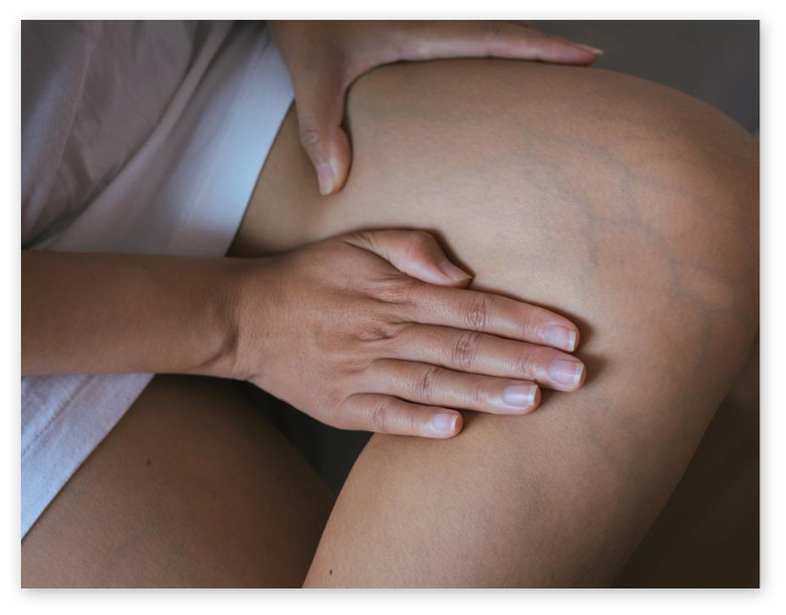 Vein disease illustration